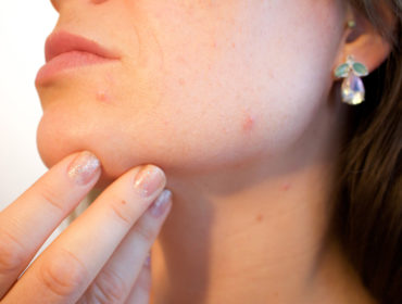 5 signs that you are dealing with hormonal acne