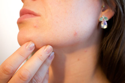 5 signs that you are dealing with hormonal acne