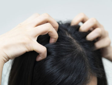 How to Deal with an Itchy Scalp