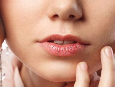 Tired of Dry Lips & Cheeks? Try These Tips