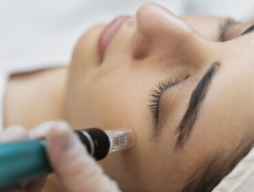 The Truth About Microneedling: Myths vs. Reality